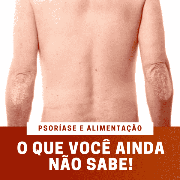 psoríase e alimentação